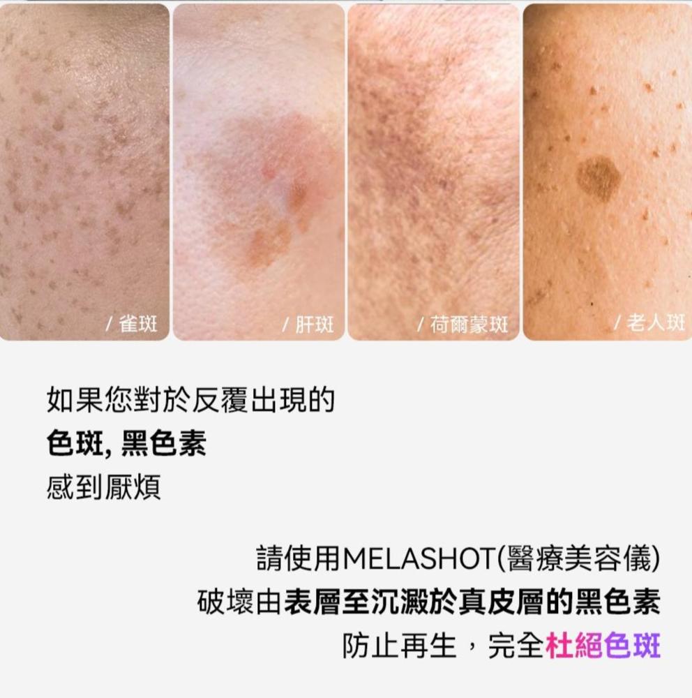 Melashot 去斑醫療美容儀